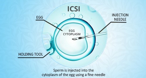 ICSI Treatment in Junagadh: Leading Specialists