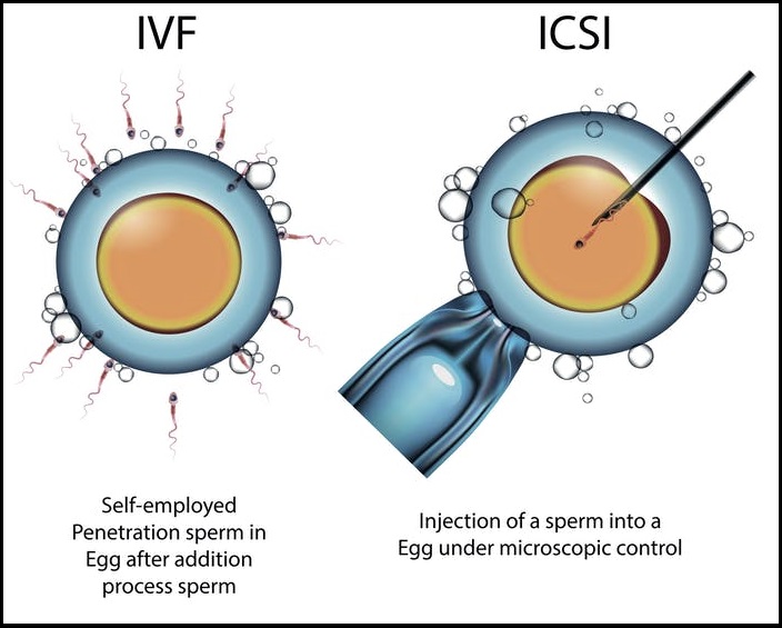 Fertility Centre in Junagadh best ivf center in junagadh ICSI treatment in Junagadh
