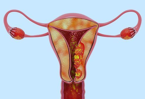 uterine tumors, fertility issues, infertility treatment, pregnancy complications, heavy menstruation, irregular cycles, fibroid removal, reproductive health, hormonal imbalance, IVF treatment, fertility centre in Junagadh, best IVF center in Junagadh, ICSI treatment in Junagadh, conception challenges, assisted reproductive techniques