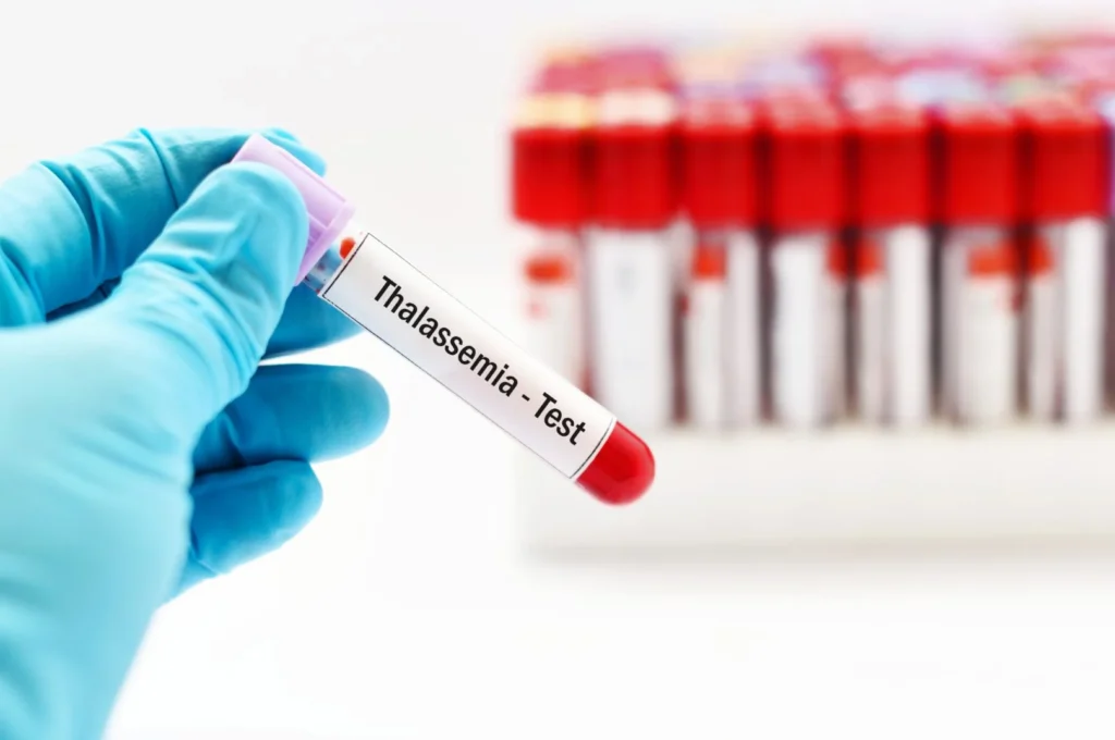 Thalassemia awareness, prenatal screening, fetal medicine, thalassemia major prevention, genetic testing during pregnancy, Unique Hospital Junagadh, best IVF center in Junagadh, fetal health checkup, thalassemia minor couple, pregnancy genetic disorders, IVF success Junagadh, advanced fetal medicine services, early detection of thalassemia, healthy pregnancy tips, reproductive health Junagadh, thalassemia screening Junagadh, prenatal genetic counseling, fetal anomaly scan Junagadh, IVF and fetal medicine, thalassemia carrier testing