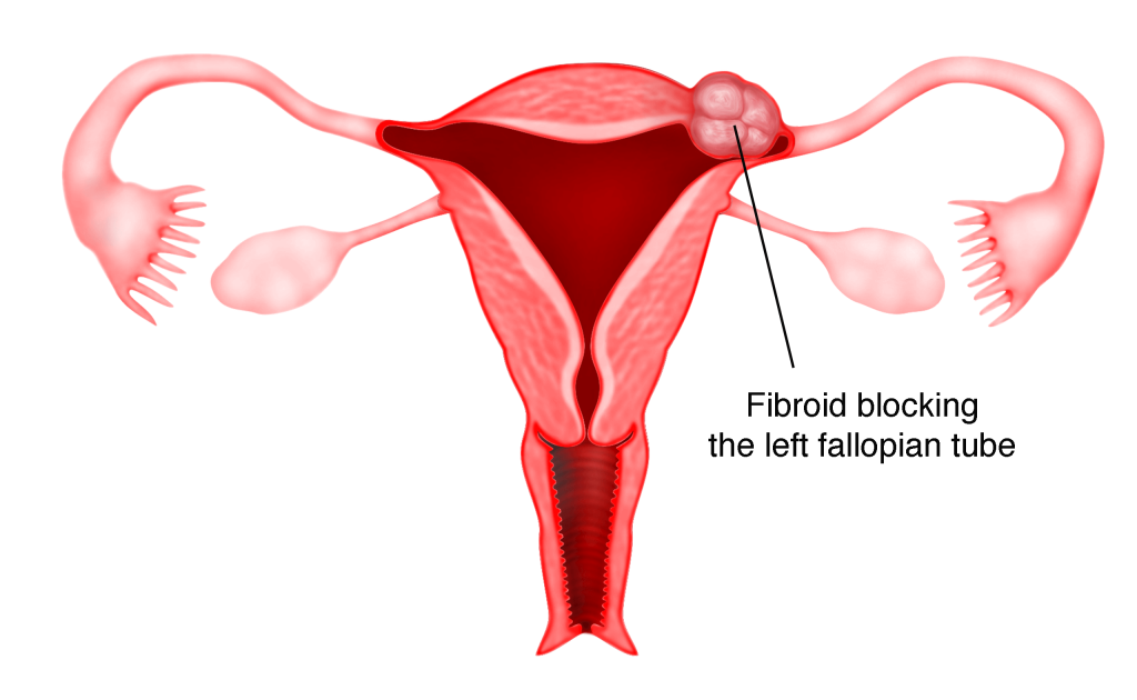 blocked fallopian tubes, fibroids and infertility, best IVF center in Junagadh, Unique IVF Junagadh, fertility center in Junagadh, ICSI treatment Junagadh, infertility treatment Junagadh, causes of female infertility, fallopian tube blockage treatment, fibroid treatment Junagadh, IVF for blocked tubes, laparoscopy for fertility, endometriosis and infertility, hysteroscopy Junagadh, reproductive health Junagadh, gynecological care Junagadh