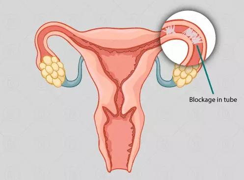 blocked fallopian tubes, fibroids and infertility, best IVF center in Junagadh, Unique IVF Junagadh, fertility center in Junagadh, ICSI treatment Junagadh, infertility treatment Junagadh, causes of female infertility, fallopian tube blockage treatment, fibroid treatment Junagadh, IVF for blocked tubes, laparoscopy for fertility, endometriosis and infertility, hysteroscopy Junagadh, reproductive health Junagadh, gynecological care Junagadh