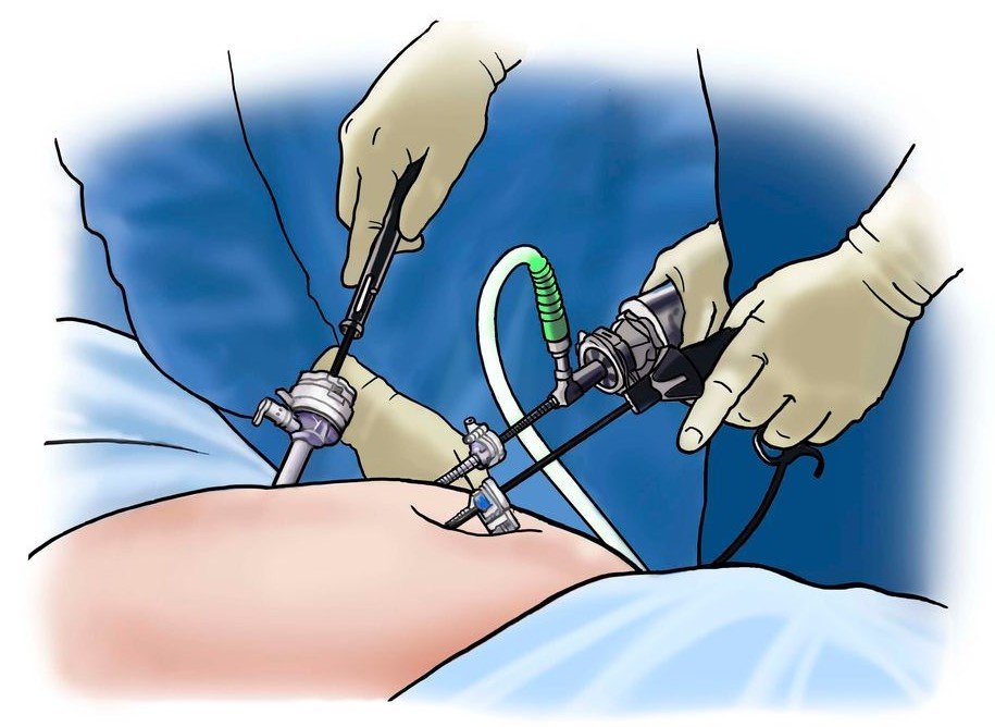 laparoscopy surgery Junagadh, gynecological laparoscopy Junagadh, best IVF center in Junagadh, minimally invasive gynecological surgery, ICSI treatment in Junagadh, ovarian cyst surgery Junagadh, laparoscopic treatment for fibroids, endometriosis surgery Junagadh, fertility laparoscopy Junagadh, Unique IVF Hospital Junagadh, advanced women’s healthcare Junagadh