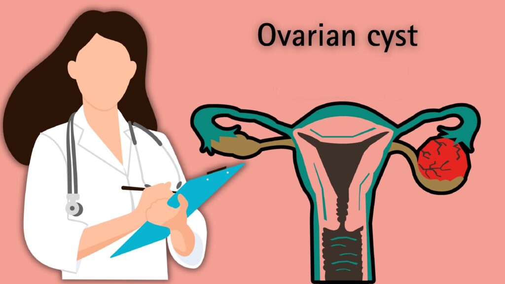 laparoscopy surgery for ovarian cysts, ovarian cyst treatment in Junagadh, best IVF center in Junagadh, fertility centre Junagadh, minimally invasive gynecology, ovarian cyst removal, symptoms of ovarian cysts, ICSI treatment in Junagadh, women’s health Junagadh, gynecology laparoscopy surgery