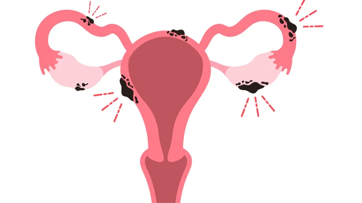 Pelvic Inflammatory Disease Junagadh, PID symptoms in women, fertility center in Junagadh, PID and infertility, best IVF center in Junagadh, ICSI treatment in Junagadh, PID causes and treatment, reproductive health Junagadh, gynecology care Junagadh, Unique IVF Hospital