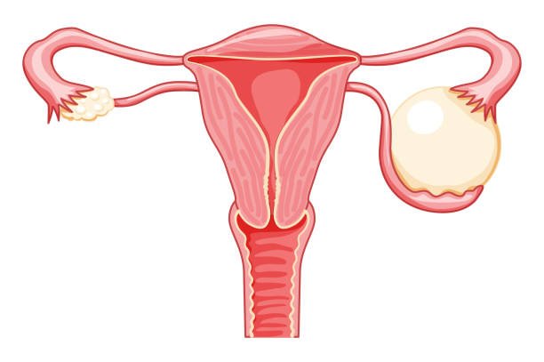 laparoscopy surgery for ovarian cysts, ovarian cyst treatment in Junagadh, best IVF center in Junagadh, fertility centre Junagadh, minimally invasive gynecology, ovarian cyst removal, symptoms of ovarian cysts, ICSI treatment in Junagadh, women’s health Junagadh, gynecology laparoscopy surgery