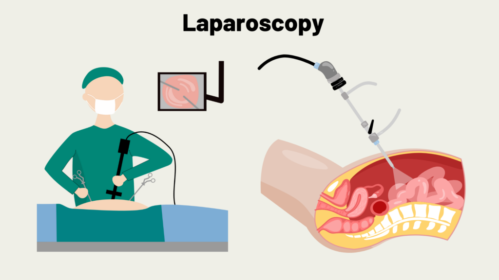 laparoscopy surgery for ovarian cysts, ovarian cyst treatment in Junagadh, best IVF center in Junagadh, fertility centre Junagadh, minimally invasive gynecology, ovarian cyst removal, symptoms of ovarian cysts, ICSI treatment in Junagadh, women’s health Junagadh, gynecology laparoscopy surgery