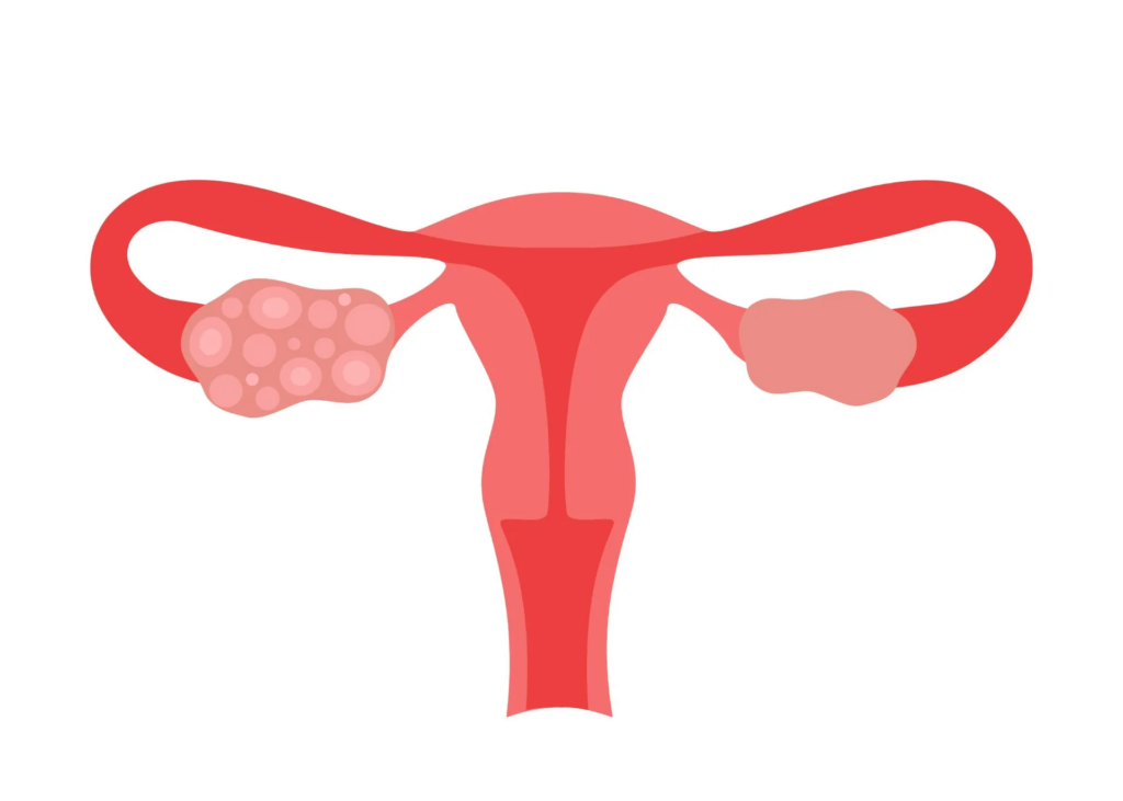 PCOS treatment Junagadh, best IVF center in Junagadh, fertility centre in Junagadh, PCOS awareness Junagadh, ICSI treatment in Junagadh, hormonal imbalance treatment Junagadh, polycystic ovary syndrome solutions, infertility treatment Junagadh, Unique IVF Hospital, IVF treatment Junagadh, PCOS and infertility management, reproductive health Junagadh
