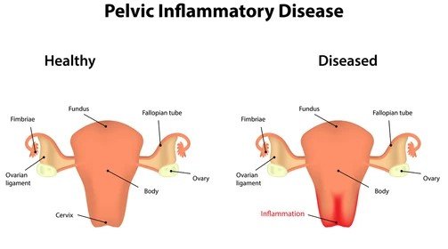 Pelvic Inflammatory Disease Junagadh, PID symptoms in women, fertility center in Junagadh, PID and infertility, best IVF center in Junagadh, ICSI treatment in Junagadh, PID causes and treatment, reproductive health Junagadh, gynecology care Junagadh, Unique IVF Hospital