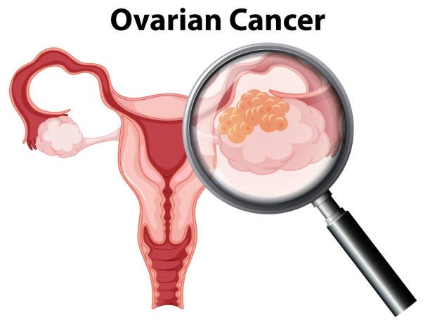 Unique IVF Hospital Junagadh, best IVF center in Junagadh, fertility centre in Junagadh, ovarian tumor treatment Junagadh, laparoscopy for ovarian tumors, ovarian tumor symptoms in women, gynecologist in Junagadh, laparoscopic surgery Junagadh, ovarian cyst and tumor management, women’s health care Junagadh, fertility and ovarian health, ICSI treatment in Junagadh, minimally invasive gynecological surgery, abdominal bloating and ovarian tumors, reproductive health Junagadh