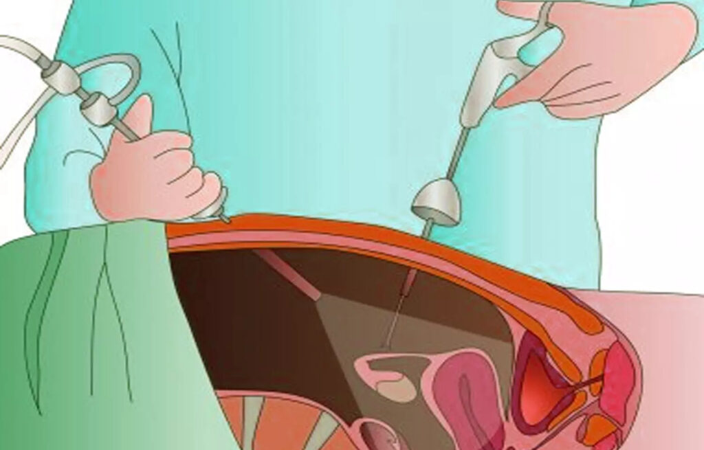 fibroid treatment in Junagadh, laparoscopic fibroid removal Junagadh, fibroid surgery Junagadh, Unique IVF Hospital fibroid treatment, uterine fibroids treatment Junagadh, laparoscopy for fibroids, best fertility centre in Junagadh, fibroid symptoms and treatment, fibroids and infertility, ICSI treatment in Junagadh, IVF centre Junagadh, minimally invasive fibroid surgery, advanced laparoscopy Junagadh, gynecologist in Junagadh, female fertility treatment Junagadh, uterine fibroid specialist Junagadh, fertility evaluation Junagadh, women’s health care Junagadh, best gynecologist for fibroids, IVF and laparoscopy combined treatment
