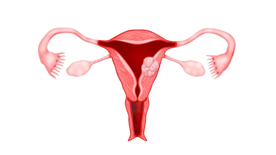 fibroid treatment in Junagadh, laparoscopic fibroid removal Junagadh, fibroid surgery Junagadh, Unique IVF Hospital fibroid treatment, uterine fibroids treatment Junagadh, laparoscopy for fibroids, best fertility centre in Junagadh, fibroid symptoms and treatment, fibroids and infertility, ICSI treatment in Junagadh, IVF centre Junagadh, minimally invasive fibroid surgery, advanced laparoscopy Junagadh, gynecologist in Junagadh, female fertility treatment Junagadh, uterine fibroid specialist Junagadh, fertility evaluation Junagadh, women’s health care Junagadh, best gynecologist for fibroids, IVF and laparoscopy combined treatment